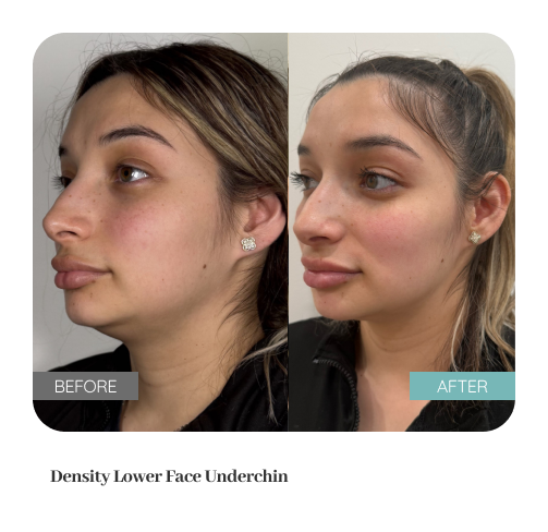 Before and after treatment result — Dr. Lanna, LC Medical Aesthetics NYC
